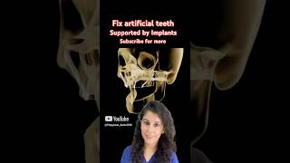 Fixed teeth with implants supported denture shorts viralvideo dental trending implants smile [upl. by Calder]