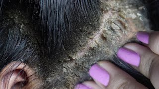 dandruff removal huge flakes scratching on head8 [upl. by Nongim]