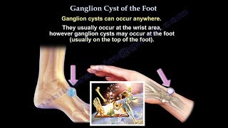 Ganglion Cyst Of The Foot  Everything You Need To Know  Dr Nabil Ebraheim [upl. by Nurav]