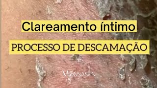 Tudo sobre o clareamento íntimo com peeling Monnaskin [upl. by Lipson]