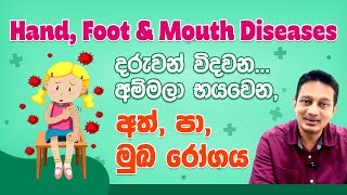 බබාලට වදදෙන අම්මලව භයකරන Hand Foot Mouth Diseaseඅත්පා මුඛ රෝගය [upl. by Stefania]