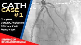 Cath Case 01 Angiography amp Angioplasty  Interpretation and Management  Bifurcation Stenting [upl. by Airdnoed]