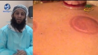 Hijama  Cupping Therapy with close up Dr Iftkhar Saifi حجامہ [upl. by Etnoj566]