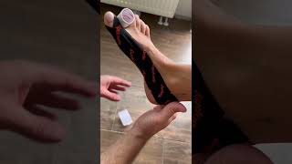 Mechanical correction for advanced Hallux Valgus taping [upl. by Aiselad]