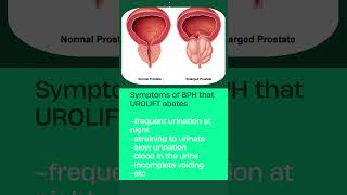 UroLift New in Health amp Technology for Prostate  Dr Himesh Gandhi [upl. by Kenley144]