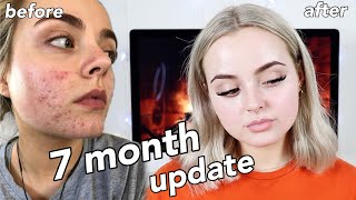 7 MONTH ACCUTANE JOURNEY WITH PICTURES  MY TIPS amp TRICKS  Conagh Kathleen [upl. by Rosamond]