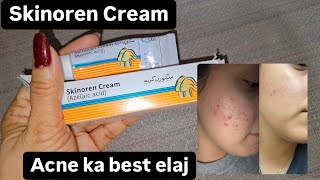 Skinoren cream  best way to get rid of acne  cehre se acne gayab [upl. by Hayyikaz]