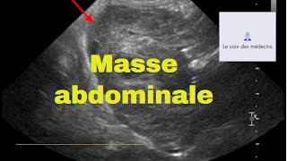 Masse abdominale [upl. by Sinnelg]