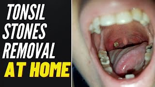 TONSIL STONE REMOVAL At Home 2021 [upl. by Hairem]