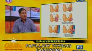 Papillary Thyroid Carcinoma [upl. by Ainsworth211]