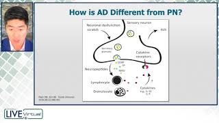 Neuroimmune Underpinnings of Prurigo Nodularis [upl. by Elag]