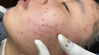 ACNE TREATMENT VU QUYNH MI  Blackheads Of Tweens 2024 EX [upl. by Ykroc]