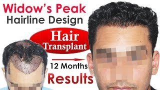 New Hair Transplant Widowss Peak Hairline Design at Medispa INDIA Jaipur Delhi By Dr Suneet Soni [upl. by Warfeld745]