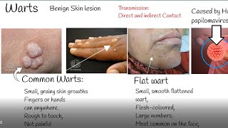 Warts causes and treatment Wart Types [upl. by Yleak]