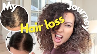 Hair Loss Treatment For Women  My Female Hair Loss Journey  TIPS ON HAIR LOSS [upl. by Perpetua]