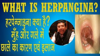 Herpangina Its Causes Symptoms and Treatment [upl. by Bendix]