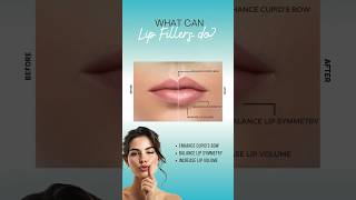 LipFiller Treatment Fuller Balanced Lips Without Surgery lip lipenhancement [upl. by Araik]