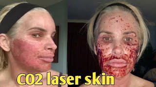 7Day Journey My CO2 Laser Skin Resurfacing Experience – Before and after chris link [upl. by Aiyekal]