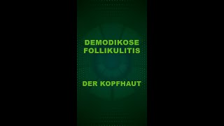 Demodikose Follikulitis der Kopfhaut [upl. by Corney]