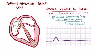 Atrioventricular AV block first second third complete degree symptoms [upl. by Allisurd]