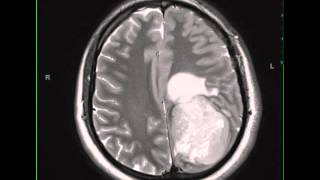 Ependymoma supratentorial [upl. by Aicercul]