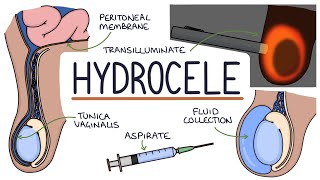 Understanding Hydroceles [upl. by Ellenad978]