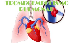 CÓMO SE PRODUCE LA TROMBOEMBOLIA PULMONAR [upl. by Adalia]