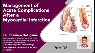 Management of Acute Complications After a Myocardial Infarction  Part 02 [upl. by Ballou]