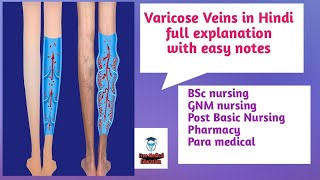 Varicose veinsfull explanation in Hindi with easy notesFreeMedicalEducationld3sfby Dr Harjass [upl. by Misty160]