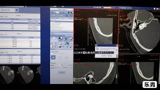 HRCT TEMPORAL BONE FILMING ON GE CT SCAN MACHINE [upl. by Jeavons]