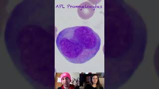 Morphological Characteristics of Promyelocytes in Acute Promyelocytic Leukemia APL [upl. by Kara-Lynn61]