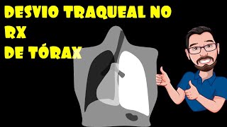 DESVIO TRAQUEAL NA RADIOGRAFIA DE TÓRAX [upl. by Disraeli647]