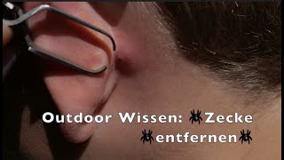 Outdoor Wissen 🕷Zecke 🕷entfernen🕷 [upl. by Acisset]