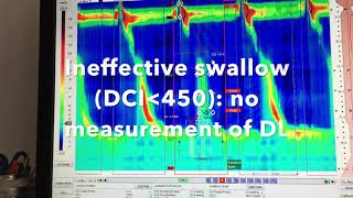 Analysis of Esophageal High Resolution Manometry ESNM Teaching Video [upl. by Toomay]