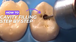 Molar tooth cavity filling process  composite filling  how to composite filling [upl. by Sirk]