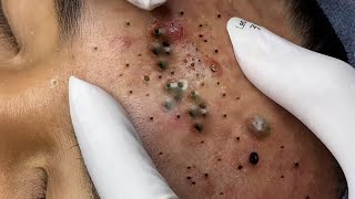 Big Cystic Acne Blackheads Extraction Blackheads amp Milia Whiteheads Removal Pimple Popping  7050 [upl. by Animlehliw]