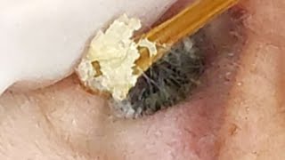 【耳掃除】953 耳かき 〜これまた大物！耳垢の検査？！〜 earwax [upl. by Bradford]