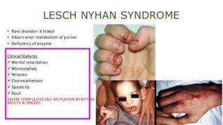 Lesch Nyhan syndrome A defect of Hypoxanthine Guanine phosphoribosyltransferase enzyme [upl. by Plumbo]