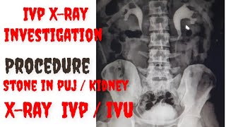 IVP  IVU Xray Special Investigation  Intravenous Urography  IVU patient positioning  PUJ stone [upl. by Ecal]