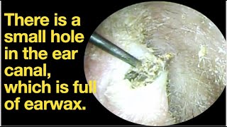 There is a small hole in the ear canal which is full of earwaxear wax removal ASMR [upl. by Wendie]