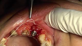 Palatal Roll  Peri Implant Soft Tissue Augment [upl. by Loriner920]