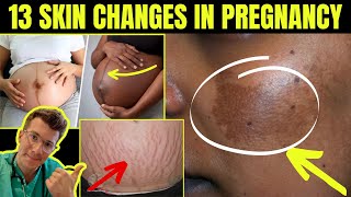 Doctor explains 13 SKIN SIGNS AND CHANGES SEEN IN PREGNANCY plus real life clinical photos [upl. by Esorylime]