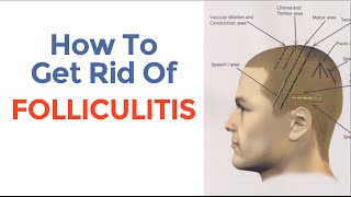 How To Cure Folliculitis And Decrease Excessive Hair Loss [upl. by Elatnahs]