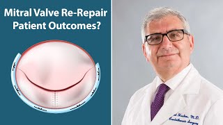 Mitral Valve ReRepair Outcomes with Dr Sabet Hashim [upl. by Hewes18]