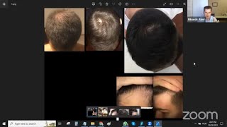 Sudden Hair Loss From Accutane And Early Signs Of Alopecia Areata [upl. by Sofie]