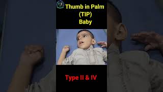 CP CLINICAL SIGNS  Thumb in Palm Deformity  Type II amp IV  Cerebral palsy [upl. by Anastasie126]