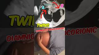 Double joy Twins ultrasound  Diamniotic Monochorionic  Girls pregnancy babyshorts [upl. by Clementius443]