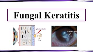 Fungal Keratitis [upl. by Astrix]