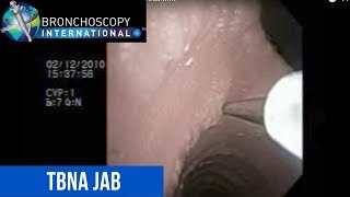 Flexible Bronchoscopy Basic Techniques 6  TBNA Jab [upl. by Deeann]