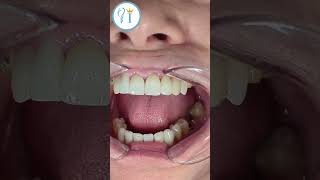 Another smile makeover🦷smiledentist orthodontist dentist smile teeth veneers beforeandafter [upl. by Harpp193]